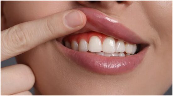 Key Features of Laser Gum Therapy