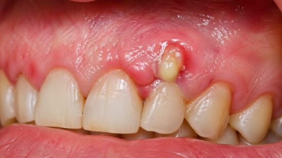 Pus or Signs of Infection