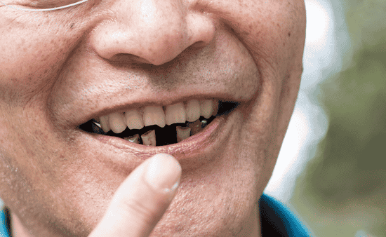 Long-Term Oral Health Issues