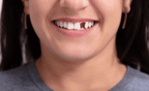 The Hidden Dangers of Ignoring Missing Teeth